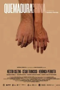 Queimadura Chinesa